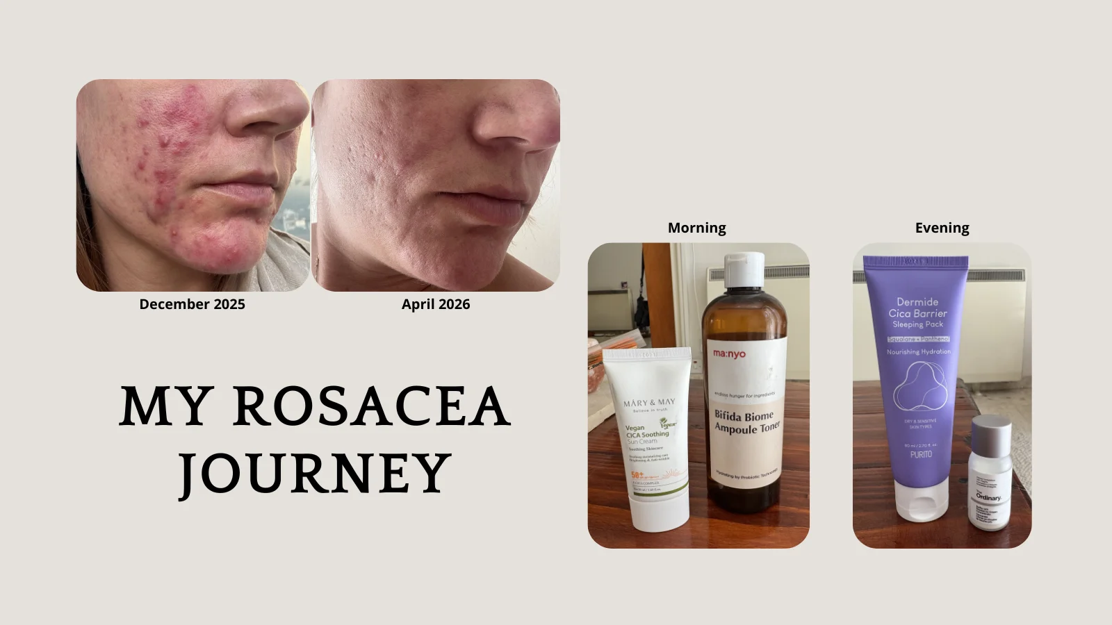 My Journey with Rosacea — I’ve struggled with my skin for the past 10–15 years.

For a long time, it was treated as acne. Doctors and dermatologists prescribed different acne t...
